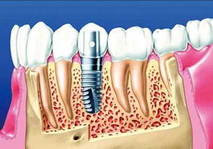 种植牙到底能用多久(种植牙能用多久?)