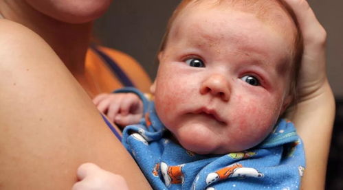 想了解一下湿疹宝宝喝什么奶粉好有影响吗(长湿疹的宝宝喝什么奶粉)