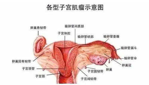 子宫肌瘤坚持艾灸这几个穴位,很多妇科疾病都消失了