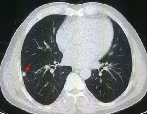 乳腺专家王劲 甲状腺结节 乳腺结节 肺结节,女性为何容易长各种结节