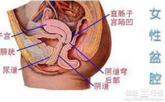 得了盆腔积液严重吗