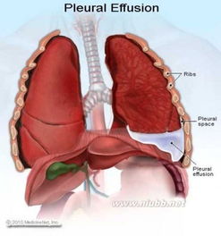 温故而知新 类肺炎性胸腔积液 