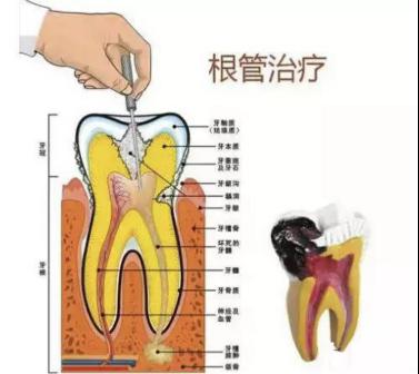 牙神经暴露了该怎么办