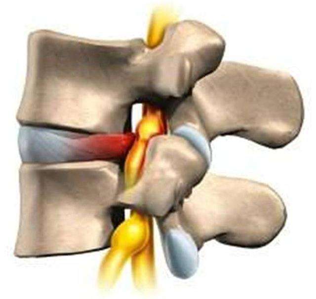 腰痛是不是得了腰椎间盘突出呢