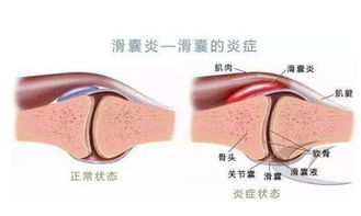 膝关节滑囊炎该如何治疗(膝关节滑囊炎吃什么药效果好)