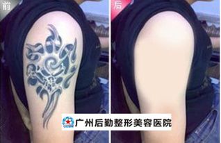 广州激光洗纹身 让生活从新开始