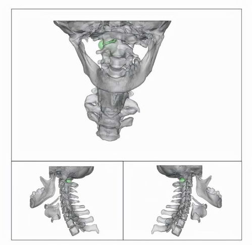 3D打印助力绍兴市人民医院神经外科团队完成高位颈椎神经鞘瘤高难度微创手术