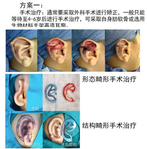 为什么先天性新生儿会出现耳廓畸形 是什么原因导致的