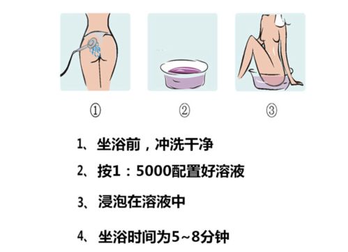 得了痔疮不要慌,这几种方法你试过了吗