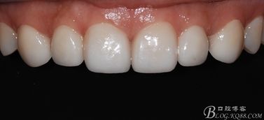 关闭牙齿缝隙 美加超薄瓷贴面修复案例赏析1