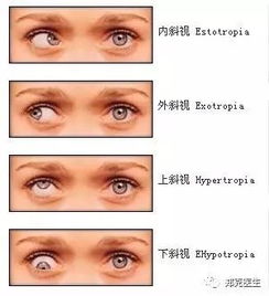 究竟是眼距宽还是 斗鸡眼 学会这招在家就能轻松筛查斜视