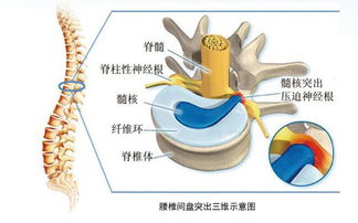 腰椎间盘突出的形成原因及过程 