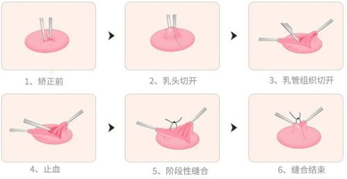 杭州做乳头内陷矫正手术多少钱呢 