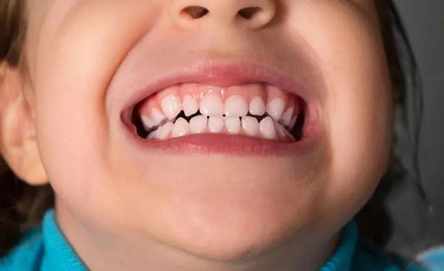 儿童牙齿畸形有哪些情况 做到这3点能预防牙齿畸形