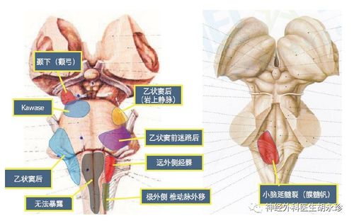 脑干出血,我们到底咋办