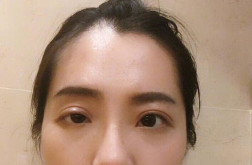 为了美 割双眼皮 的女人最后怎样了 这3个 成果 不妨看看