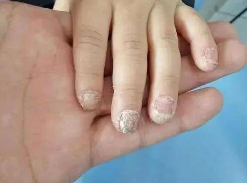 儿童灰指甲初期图片 