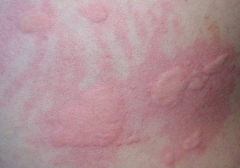 湿毒皮肤病是什么症状