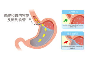 不仅烧心反酸,胃食管反流的 杀伤力 比你想的还凶残