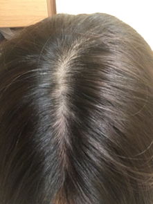 之前 细软发,头皮还油,掉发也严重 头发看起来很少 感觉快要有秃头的风险了 头发产品 个人护理 小红书 