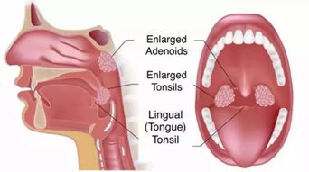 腺样体肥大能自愈吗 儿童腺样体肥大，中医保守治疗有效果吗？ 