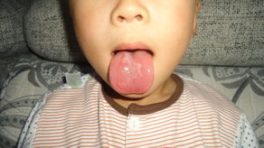 我儿子现在3岁.舌头很长时间了.几个月吧 .都发现如图片中的似的.没有烫着.问孩子.孩子说不疼. 