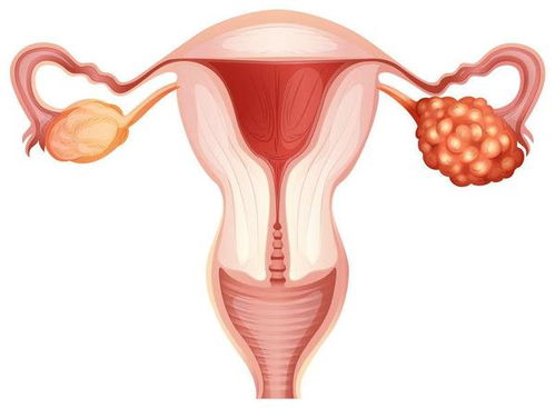卵巢癌发出的第一个信号,经常是这种异常,三类人应该检查一下