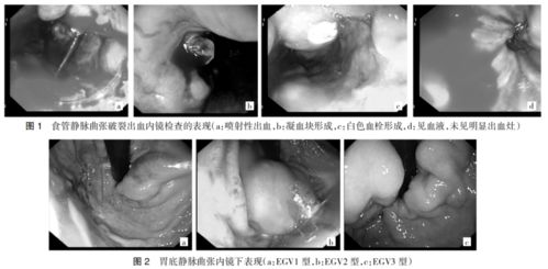 文献推荐 内镜下聚桂醇联合组织胶注射治疗食管胃底静脉曲张出血的临床应用