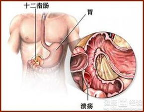 慢性浅表性胃炎可以吃哪些水果