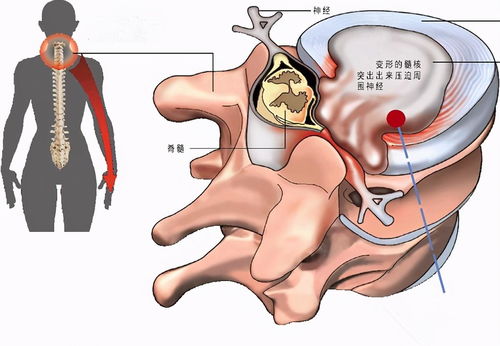 得了颈椎病为什么会出现手麻 手疼呢