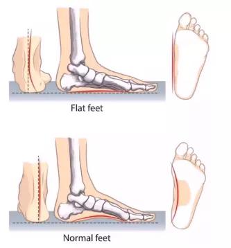 走路脚疼 小腿粗 X型腿 快来看你的脚底,是不是又扁又平