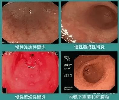 健康科普丨胃总是隐隐作痛,到底是什么毛病,不外乎是以下五四种情况