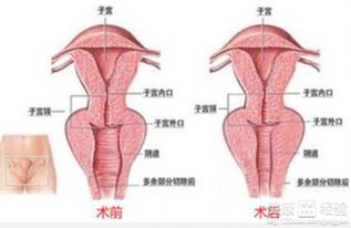 子宫脱垂手术后遗症