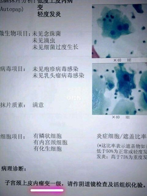 感染HPV51和16 61,局部CIN1级,才25岁的我要疯了