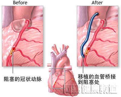 我院成功完成两例不停跳心脏搭桥手术