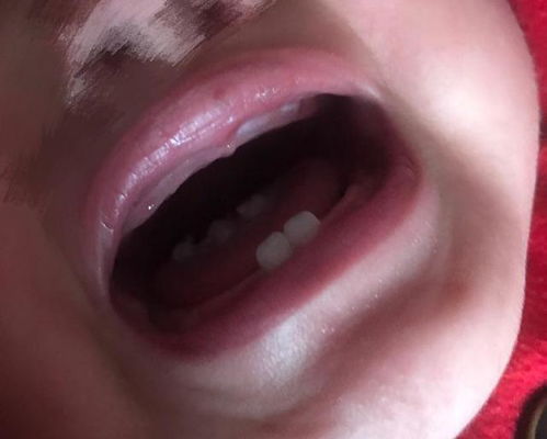 宝宝出牙前有症状,对照出牙时间和顺序,看看你家娃有没有达标