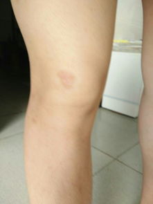 我腿上的这种疤痕,当兵过得了嘛 