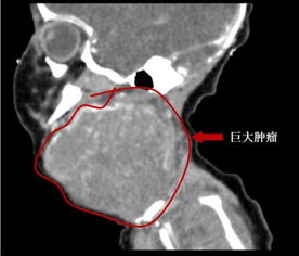 新生儿颈部挂另一个 脑袋 呼吸困难 实为肿瘤