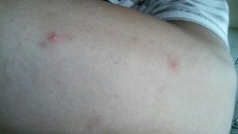 背上手臂上长了很多类似痘痘的小疙瘩,背上很久了,手臂最近才会,大的会红肿,压到有点痛,看起来里边有 