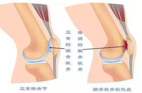 有一种膝痛,叫髌骨软化 到底什么叫髌骨软化