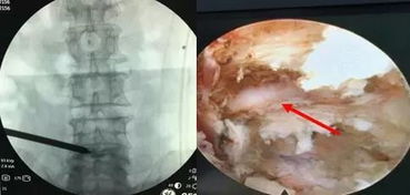 得了腰椎间盘突出别害怕,我院为75岁患者行微创治疗,术后24小时出院 