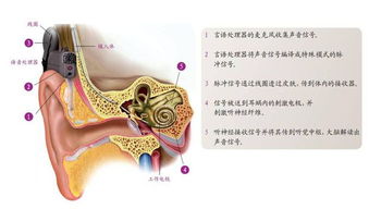 人工耳蜗的工作原理是什么？