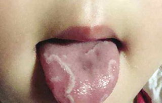 舌苔发白用棉签沾冷水洗的掉吗 