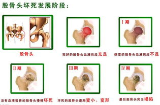 骨股头坏死三期不疼痛只是关节功能受限如何治疗【缺血性股骨头坏死】