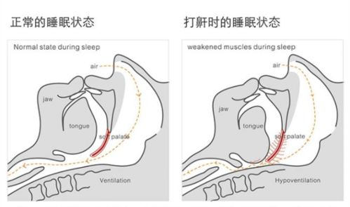 什么是睡眠呼吸暂停