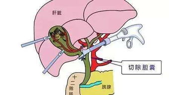 做完ercp后要切胆囊吗(做完ercp手术后多久可以出院)