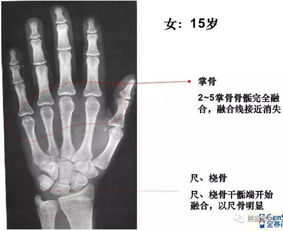 收藏丨骨龄图谱 方便随时对照