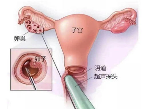 试管婴儿打促排卵针，腹腔取卵疼不疼啊手术风险大不大