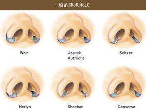鼻翼缩小手术内切和外切的区别 哪个效果明显 内切会不会反弹 
