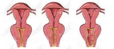 缩阴手术一次就有效果 为什么有人说做完缩阴术后不紧